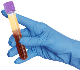 Lipemic blood sample Lipemic blood sample